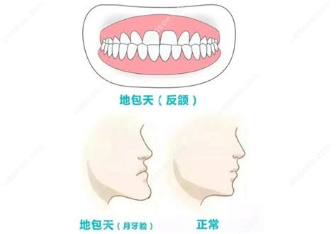 地包天牙齒|科普文：天包地和地包天有什麼區別